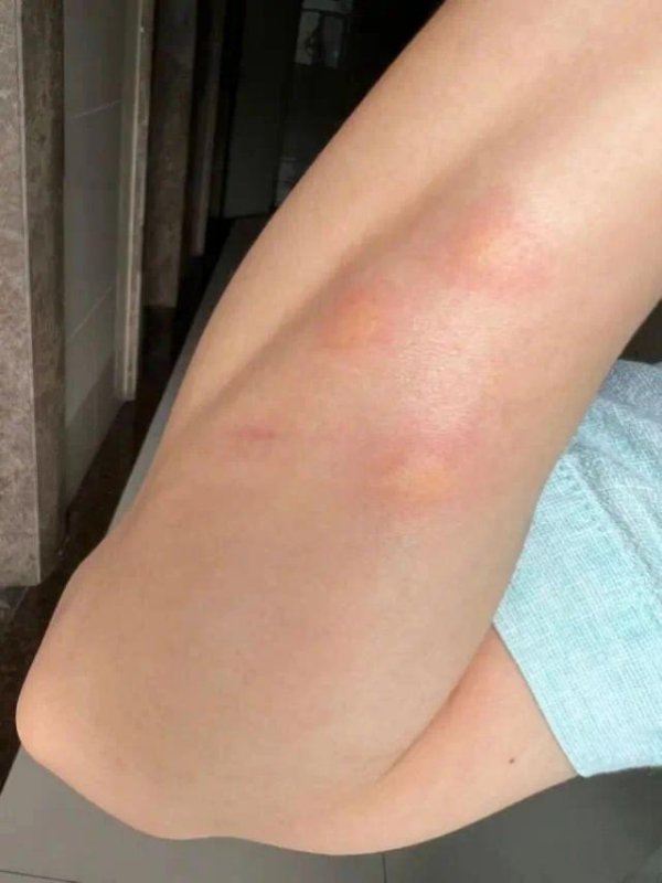 长宏网 最近！身上突然不明原因痒一下、又红又肿，赶紧打开这篇！（不是蚊子）